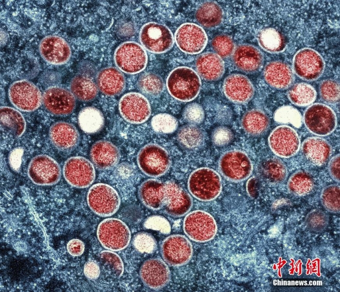 當?shù)貢r間2022年7月26日，美國馬里蘭州，在實驗室培養(yǎng)的感染細胞(棕色)中發(fā)現(xiàn)的猴痘顆粒(橙色)的彩色透射電子顯微圖。世界衛(wèi)生組織最近宣布，不斷擴大的猴痘疫情為全球緊急情況。這是世衛(wèi)組織的最高警戒級別，但這一級別并不一定意味著疾病具有特別的傳染性或致命性。圖片來源：視覺中國
