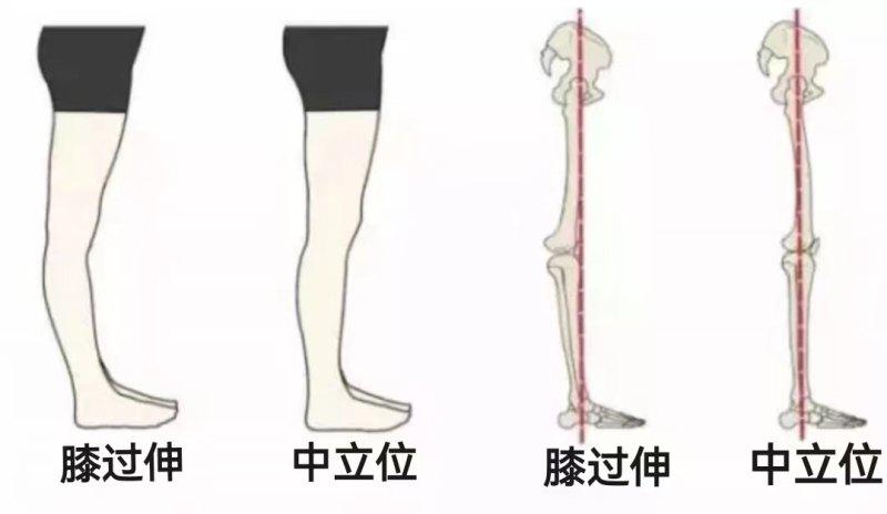 膝過(guò)伸是什么?