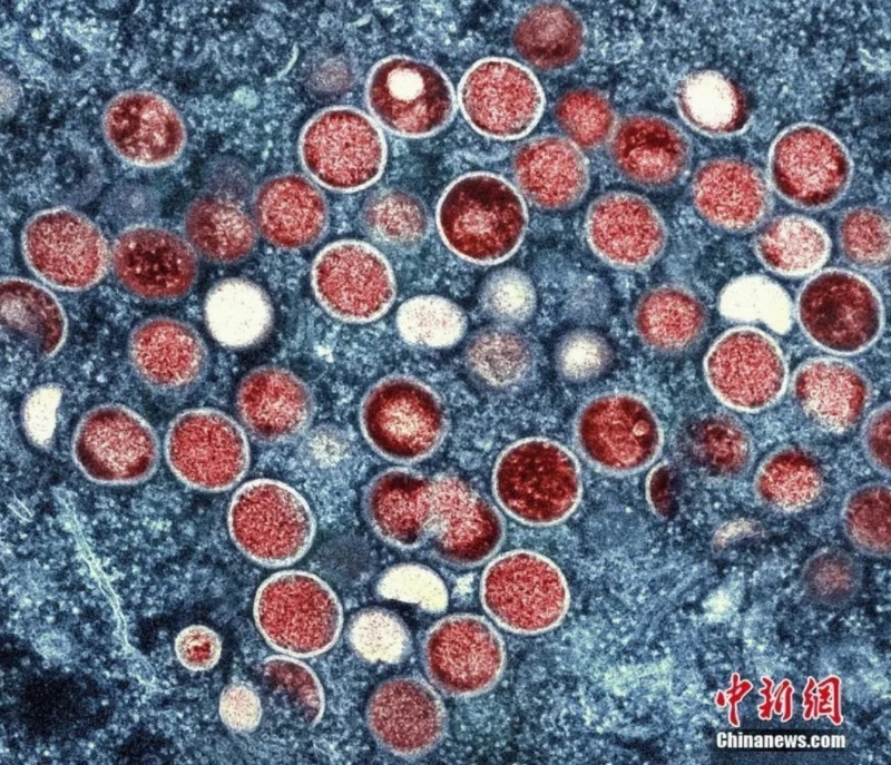 資料圖：猴痘顆粒的彩色透射電子顯微圖。.png